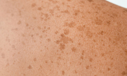 Aceite de hipérico para manchas en la piel